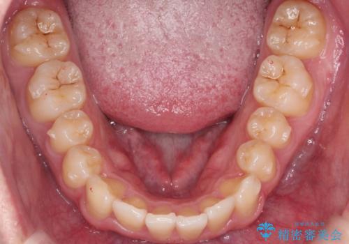 前歯のすき間、犬歯の異所萌出　乳歯を抜かずに矯正の治療中