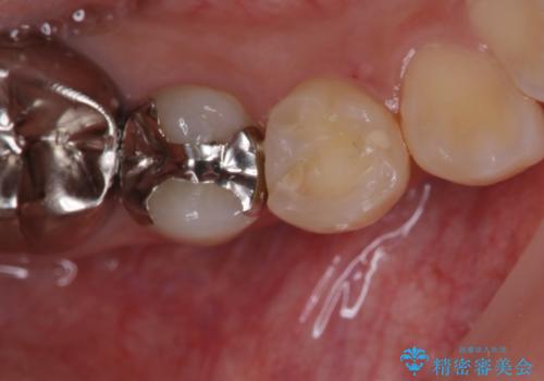 歯の形が気になる セラミックでキレイな歯に!の症例 治療前