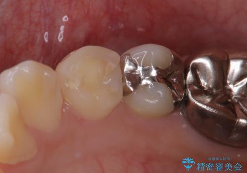 歯の形が気になる セラミックでキレイな歯に!の治療前