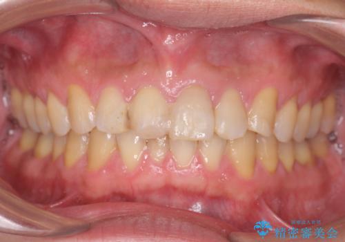 転んで前歯が欠けてぐらぐらに 歯の神経も死んでしまったの治療前