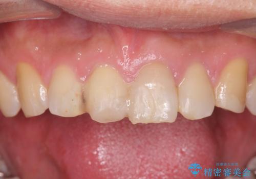 転んで前歯が欠けてぐらぐらに 歯の神経も死んでしまったの治療前