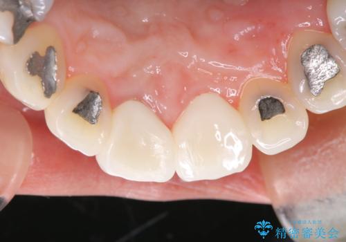器具が破折して残ったままの前歯の治療後
