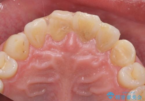 転んで前歯が欠けてぐらぐらに 歯の神経も死んでしまったの治療前