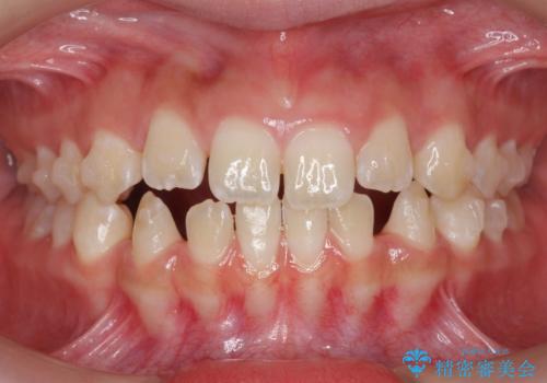 人の印象は歯並びから! 実は…美容医療より効果抜群!! コスパ重視ならすきっ歯の矯正治療の治療中