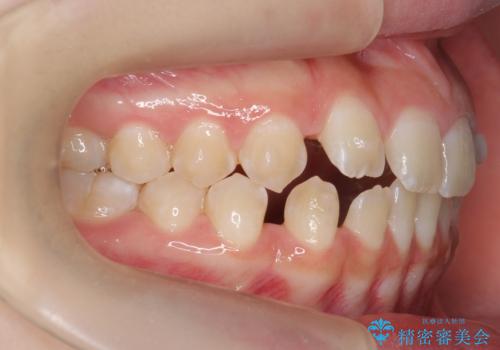 人の印象は歯並びから! 実は…美容医療より効果抜群!! コスパ重視ならすきっ歯の矯正治療の治療中