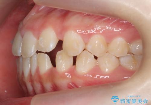 人の印象は歯並びから! 実は…美容医療より効果抜群!! コスパ重視ならすきっ歯の矯正治療の治療中