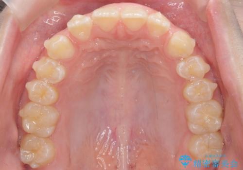 人の印象は歯並びから! 実は…美容医療より効果抜群!! コスパ重視ならすきっ歯の矯正治療の治療中
