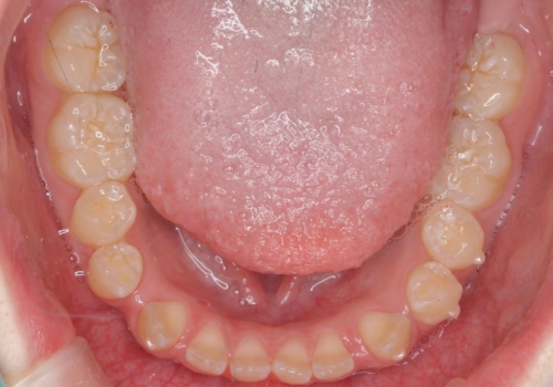 人の印象は歯並びから! 実は…美容医療より効果抜群!! コスパ重視ならすきっ歯の矯正治療の治療中