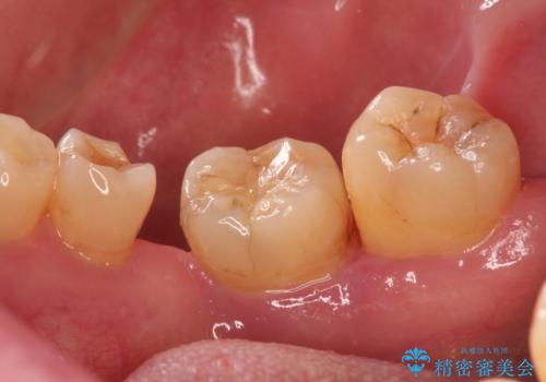 奥歯で咬むと痛いの症例 治療前