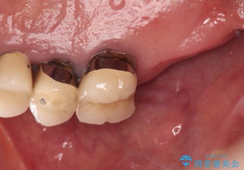 奥歯で咬むと痛いの治療前