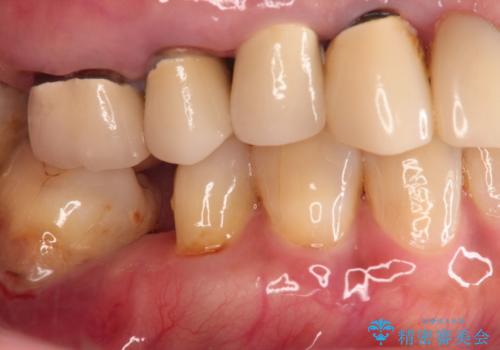 奥歯で咬むと痛いの治療前