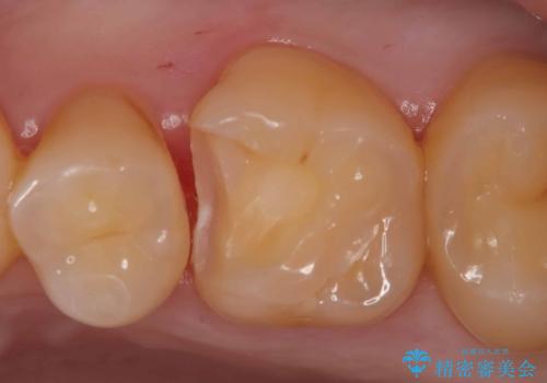 【ハイブリッドインレー】定期検診で見つかった虫歯!の治療中