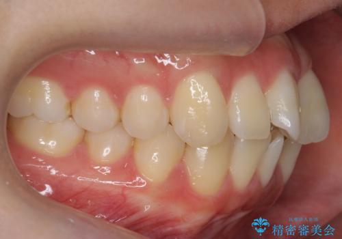 インビザライン モニター治療 前歯のねじれをまっすぐに の治療前