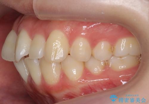 インビザライン　モニター治療　前歯のねじれをまっすぐに　の治療前