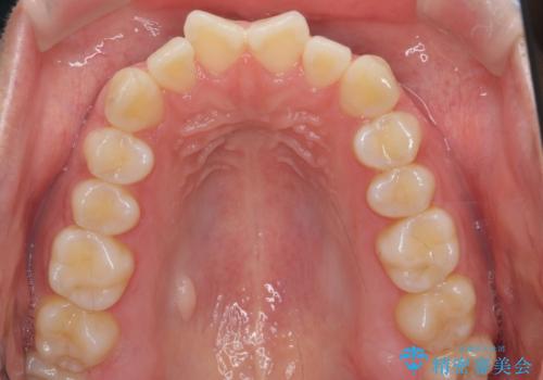 インビザライン モニター治療 前歯のねじれをまっすぐに の治療前