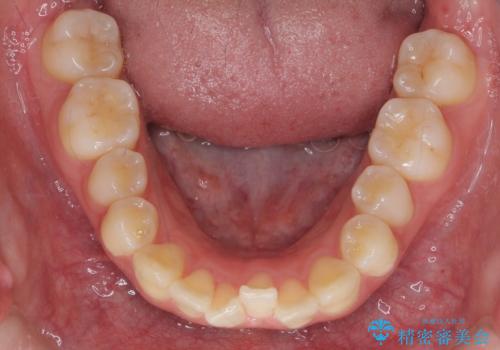 インビザライン　モニター治療　前歯のねじれをまっすぐに　の治療前