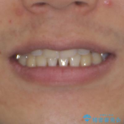 抜歯矯正で八重歯を改善 インビザライン矯正治療の治療後(顔貌)