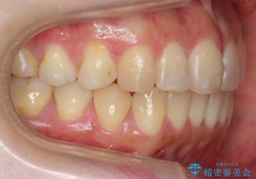 前歯を引っ込めたい 歯を抜かずにマウスピースでの治療後