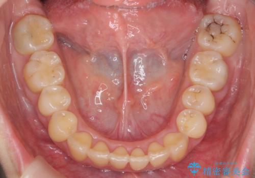 前歯を引っ込めたい 歯を抜かずにマウスピースでの治療後