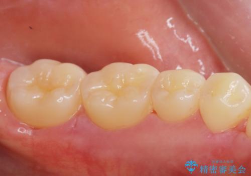 下あごの骨隆起が気になる。の治療後