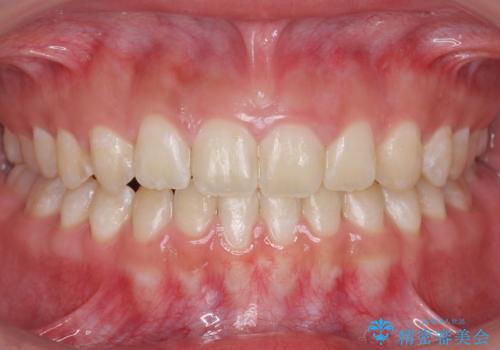 人の印象は歯並びから! 実は…美容医療より効果抜群!! コスパ重視ならすきっ歯の矯正治療の症例 治療後