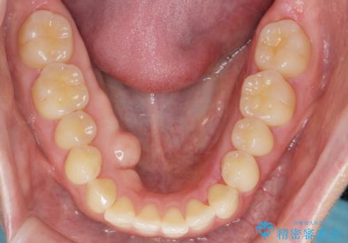 下あごの骨隆起が気になる。の症例 治療後