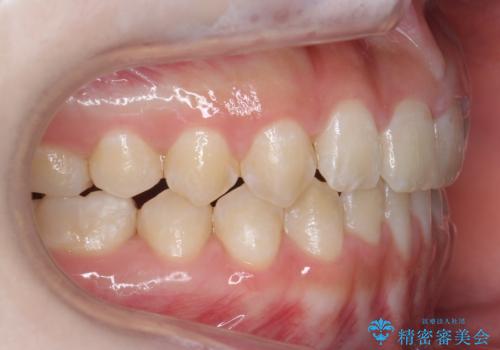 人の印象は歯並びから! 実は…美容医療より効果抜群!! コスパ重視ならすきっ歯の矯正治療の治療後