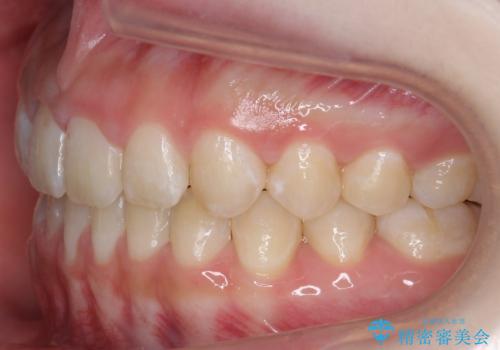 人の印象は歯並びから! 実は…美容医療より効果抜群!! コスパ重視ならすきっ歯の矯正治療の治療後