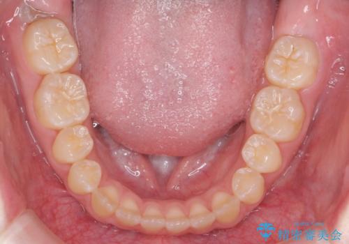 人の印象は歯並びから! 実は…美容医療より効果抜群!! コスパ重視ならすきっ歯の矯正治療の治療後