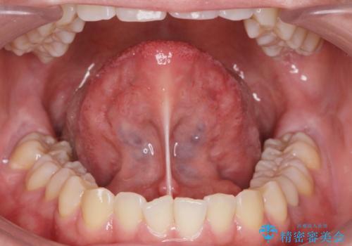 舌が動かしにくい。の症例 治療前