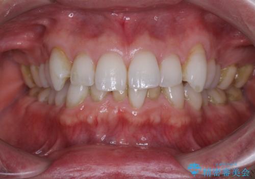 中等度歯列不正　インビザライン・モデレートによる矯正治療の症例 治療前