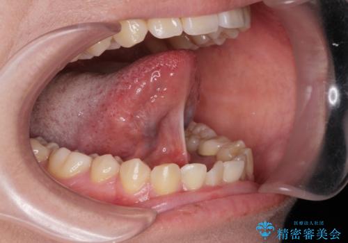 舌が動かしにくい。の治療前