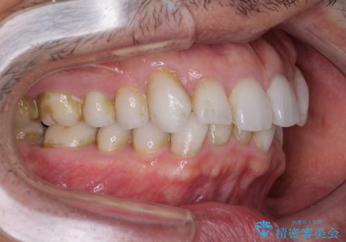 中等度歯列不正　インビザライン・モデレートによる矯正治療の治療前