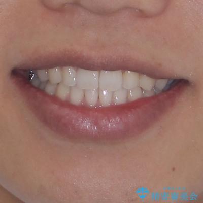 前歯のデコボコとクロスバイト インビザライン矯正治療の治療後(顔貌)
