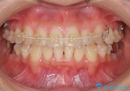 正中のズレ、引っ込んだ前歯の矯正の治療中