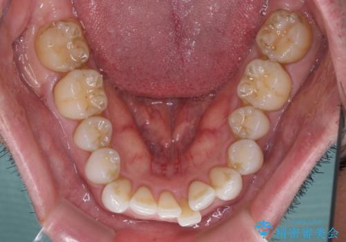 中等度歯列不正　インビザライン・モデレートによる矯正治療の治療前
