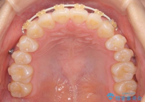 正中のズレ、引っ込んだ前歯の矯正の治療中