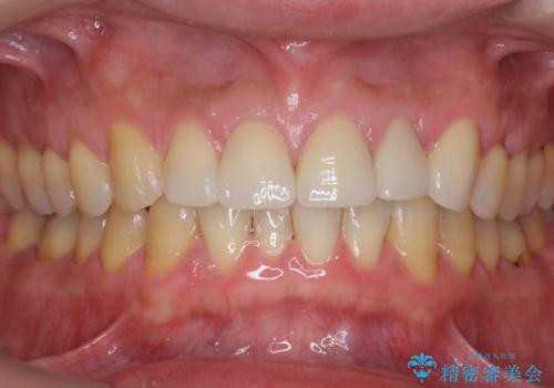 転んで前歯が欠けてぐらぐらに 歯の神経も死んでしまったの治療後