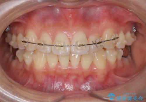 正中のズレ、引っ込んだ前歯の矯正の治療中