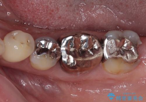 銀歯の下のむし歯で欠けてしまった歯 オールセラミッククラウン治療の治療前