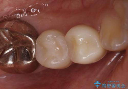 歯の形が気になる　セラミックでキレイな歯に!の治療後