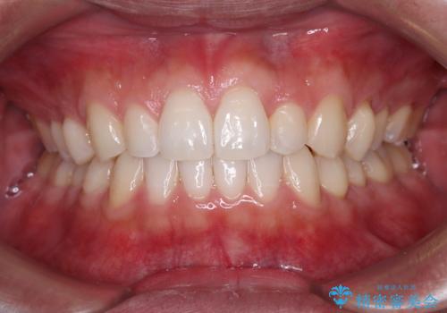 前歯のデコボコとクロスバイト　インビザライン矯正治療の症例 治療後