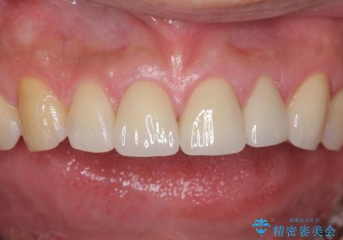 転んで前歯が欠けてぐらぐらに 歯の神経も死んでしまったの治療後