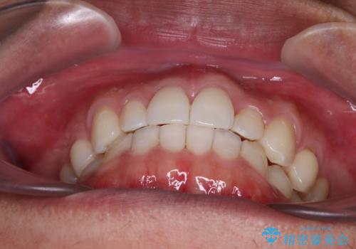 前歯のデコボコとクロスバイト　インビザライン矯正治療の治療後