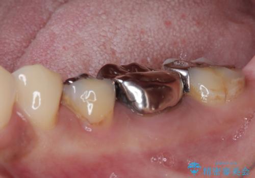 銀歯の下のむし歯で欠けてしまった歯 オールセラミッククラウン治療の治療前