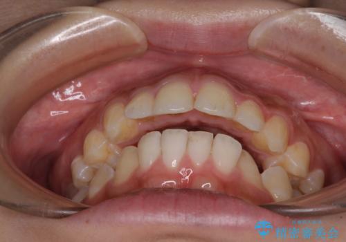 前に出ている上顎 抜歯矯正で唇を閉じやすくの治療前