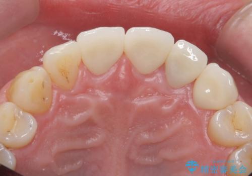 転んで前歯が欠けてぐらぐらに 歯の神経も死んでしまったの治療後