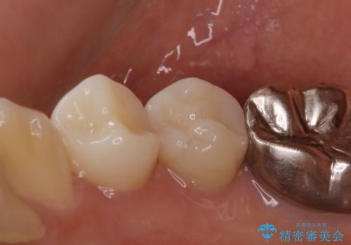 歯の形が気になる セラミックでキレイな歯に!の治療後