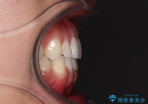 前歯のデコボコとクロスバイト インビザライン矯正治療の治療後