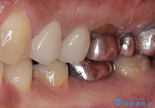 銀歯の下のむし歯で欠けてしまった歯 オールセラミッククラウン治療の治療前